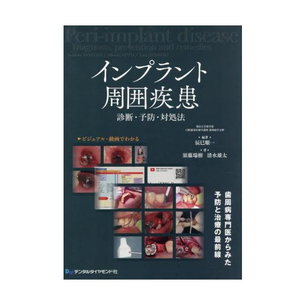 インプラント周囲疾患　診断・予防・対処法 / 辰巳順一