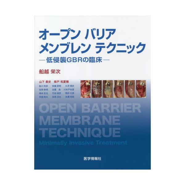 オープンバリアメンブレンテクニック　低侵襲ＧＢＲの臨床 / 船越栄次　編著