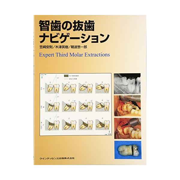 智歯の抜歯ナビゲーション popo様 智歯の抜歯ナビゲーション 智歯の