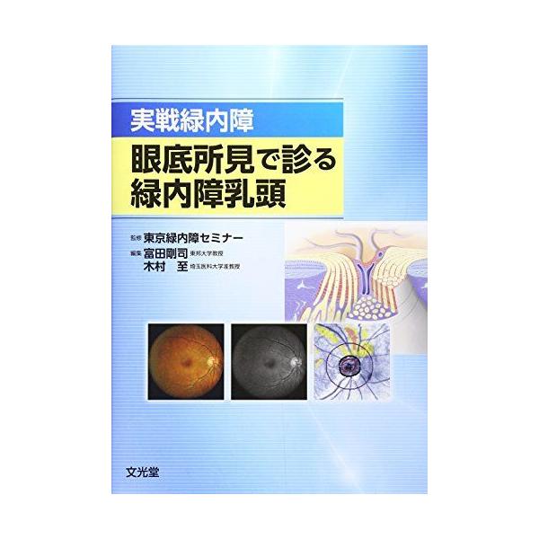 実戦緑内障 眼底所見で診る緑内障乳頭 [単行本] 東京緑内障セミナー、 剛司，富田; 至，木村