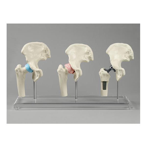 y񂹁zErler-Zimmer Ҋ֐߃Cvgpf 1115 ͌^  Ō 