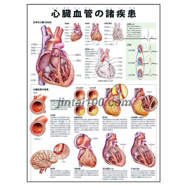 心臓血管の諸疾患」医学ポスター ポスターB3サイズ 人体解剖学図