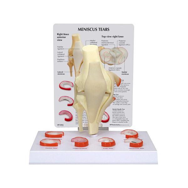 人体模型 半月板損傷 日本語訳付き GPI Anatomicals