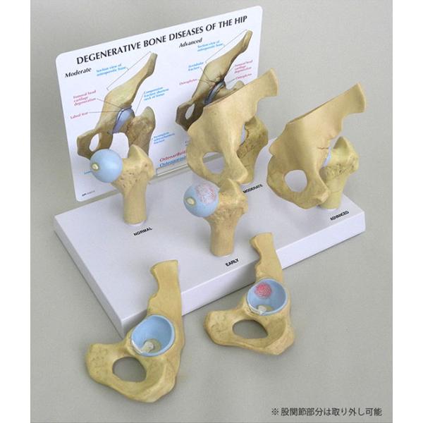 医学模型　変形性股関節症/4段階　日本語訳付き　GPI Anatomicals