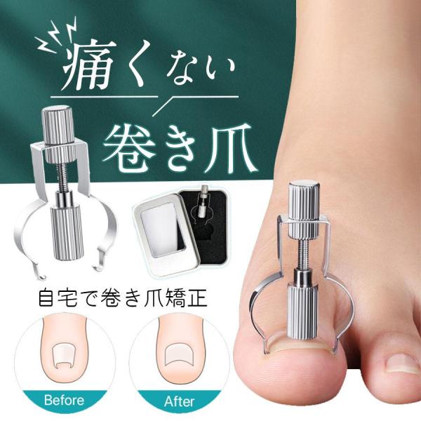 爆買 巻き爪矯正 爪切り 巻き爪クリップ ワイヤー 陥入爪 ネイルエイド