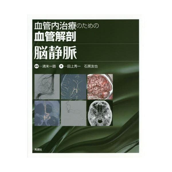 血管内治療のための血管解剖脳静脈
