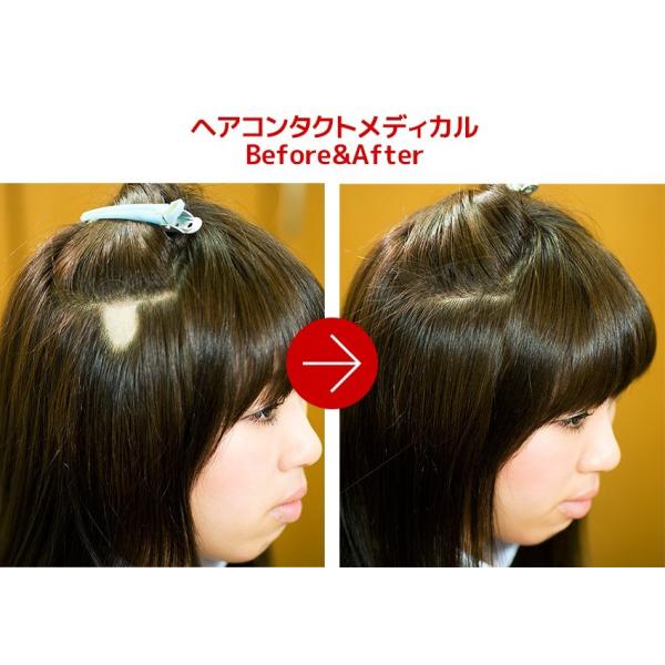 円形脱毛症 隠す 医療用 部分ウィッグ 自然 メンズ レディース シール式なら ヘアコンタクトメディカル ブラウン Buyee Buyee Japanese Proxy Service Buy From Japan Bot Online
