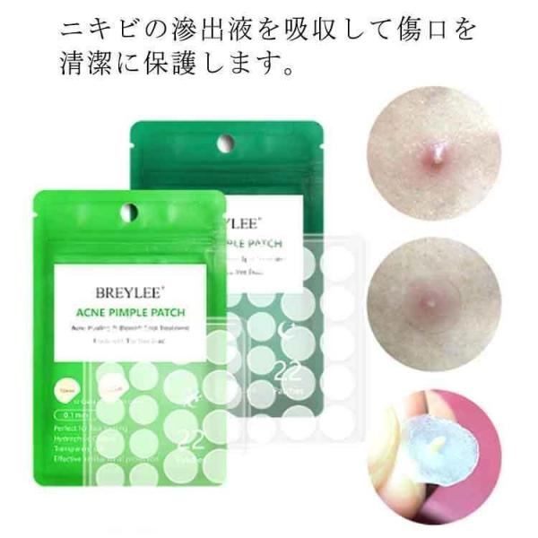 ニキビパッチ 22枚 ニキビ パッチ にきびぱっち SPOT AID にきび ニキビケア ニキビ 薬 洗顔 化粧水 クレーター ニキビ跡 薬 ニキビ対