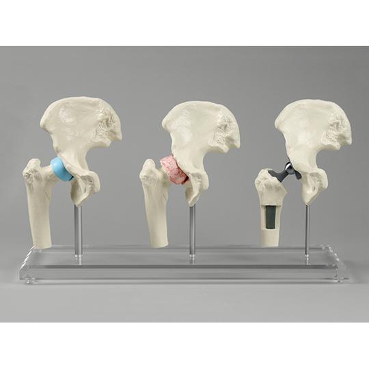 Erler-Zimmer 股関節インプラント術説明モデル 1115 (7-6513-01)