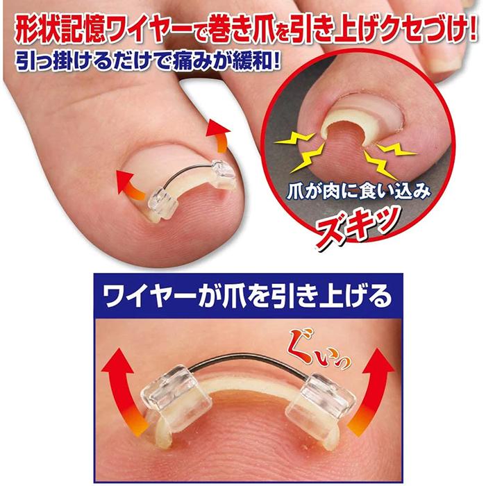 サイプラス 巻き爪ワイヤーガード 1個入 一般医療機器 ポスト投函｜aaa83900｜03