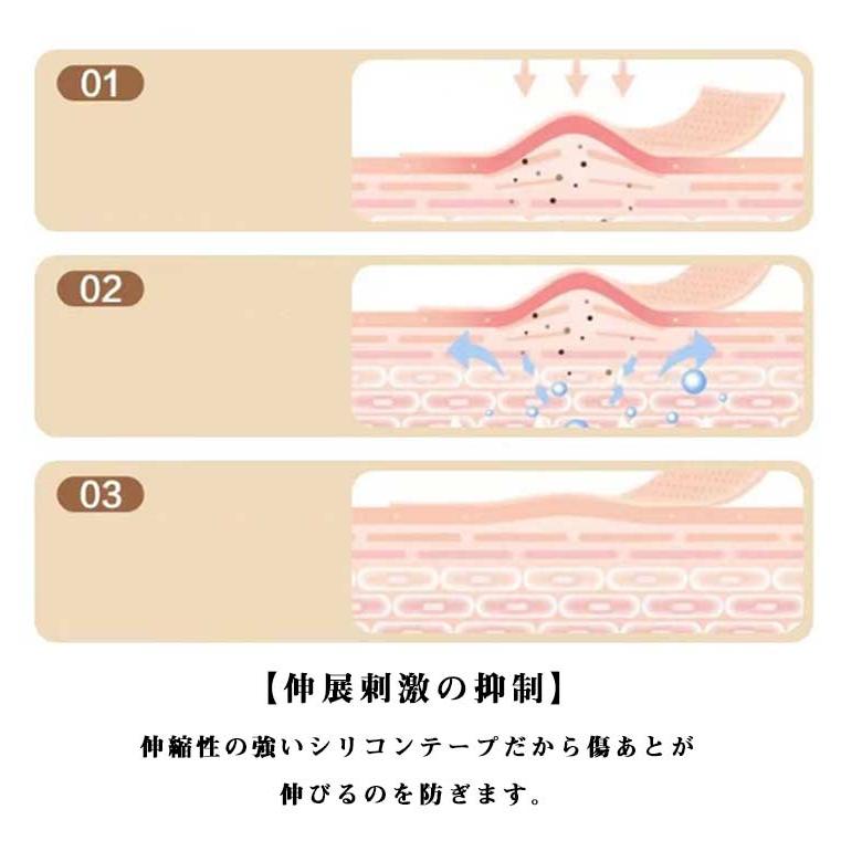 傷あとケアテープ 帝王切開 傷跡ケアテープ ケロイド テープ 貼り心地にもこだわった 傷あとケア用シリコンジェルシート 手術後 帝王切開 シリコンテー |  | 09