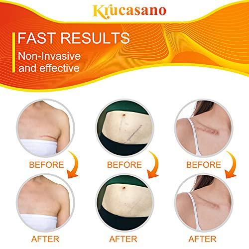 Professional Silicone Scar Sheets  Silicone Scar Removal Sheets for  並行輸入｜aozoraichiba1968｜07