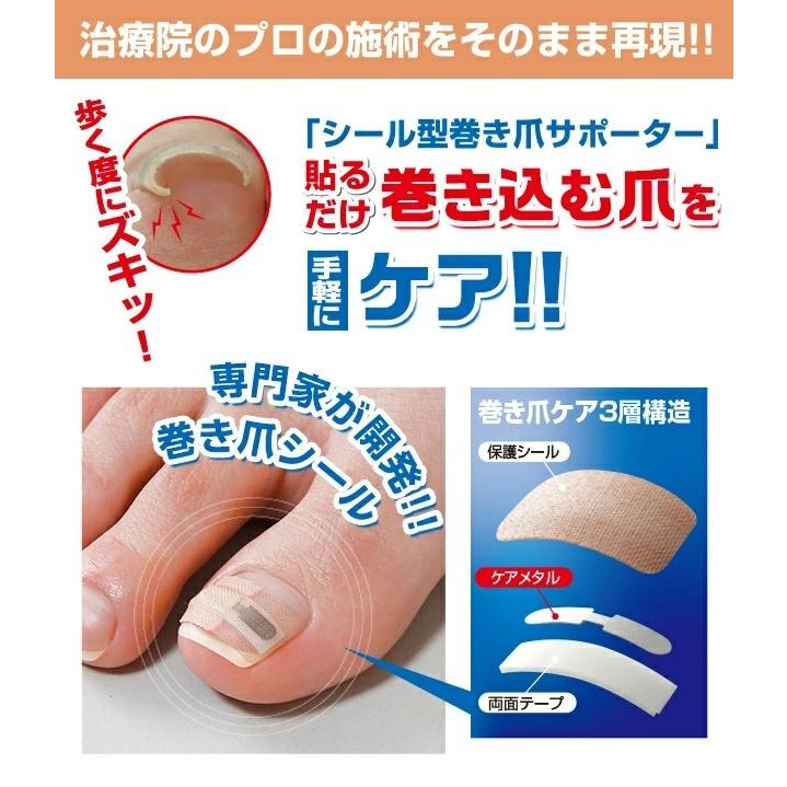 巻き爪 矯正 ワイヤー プレート テープ 巻き爪ワイヤー 巻き爪プレート