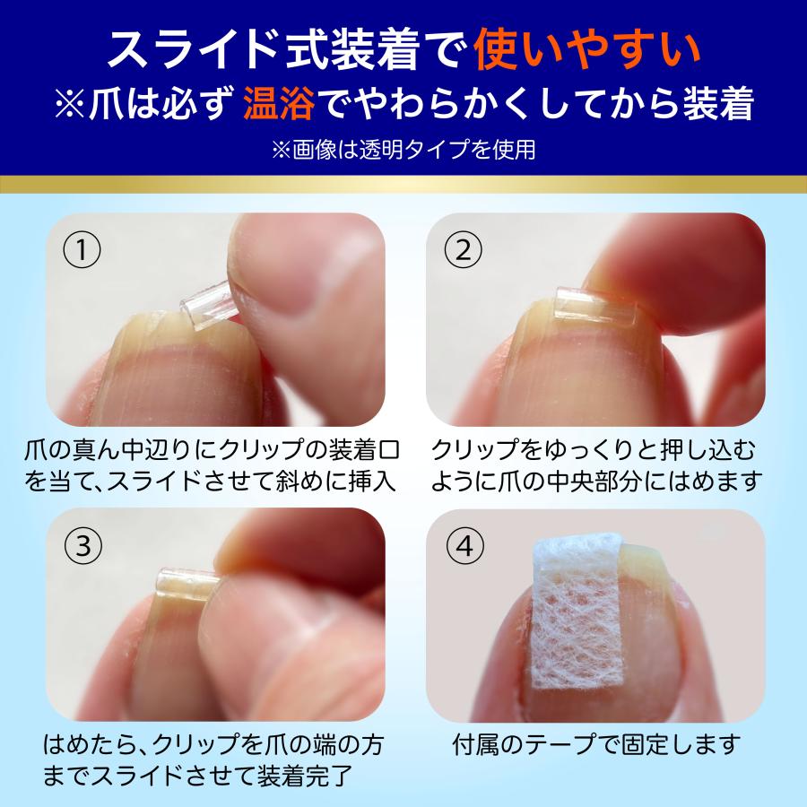 巻き爪用 ケアセット 硬質樹脂製クリップによる強固定力×温浴で巻き爪ケアが変わる