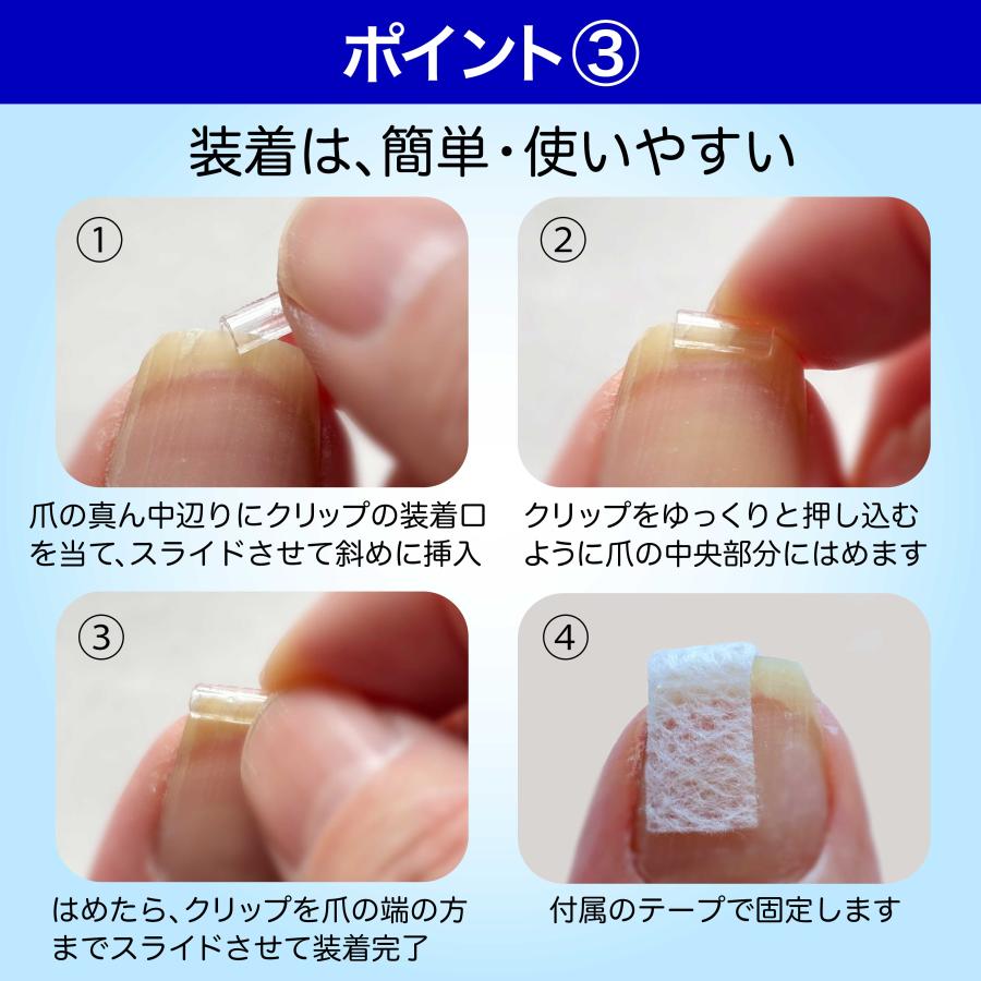 巻き爪　ネイルケア　スターターキット 巻き爪 矯正 直し方 自分で 巻爪 爪切り カールネイル 巻き爪