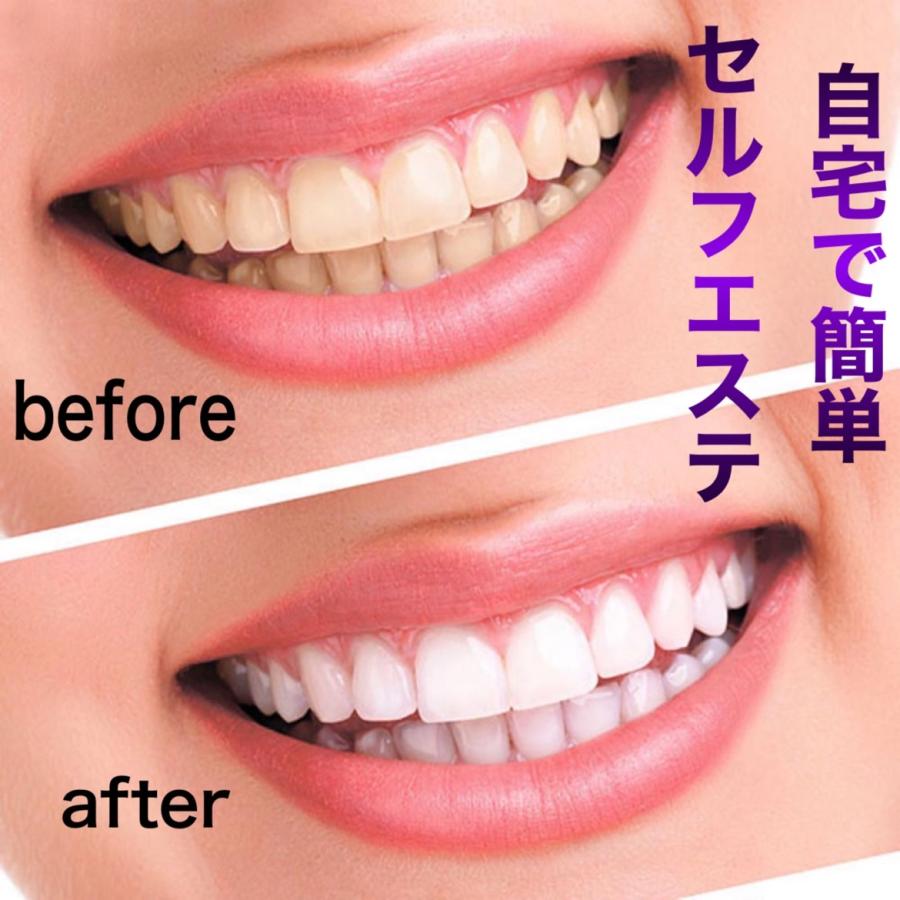 ホワイトニングシート Amazon.co.jp: 【歯科医師監修】 ホワイトニングシート歯の黄ばみ