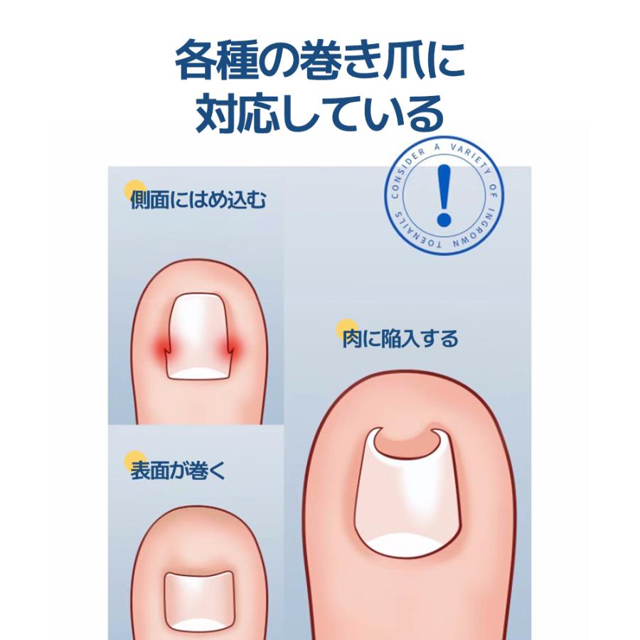 翌日発送 巻き爪 巻爪 丸まった爪 をまっすぐに 矯正  補正 する 自分で 巻き爪クリップ 矯正器具 サポーター ネイルケア  送料無料｜aya19-shop｜04