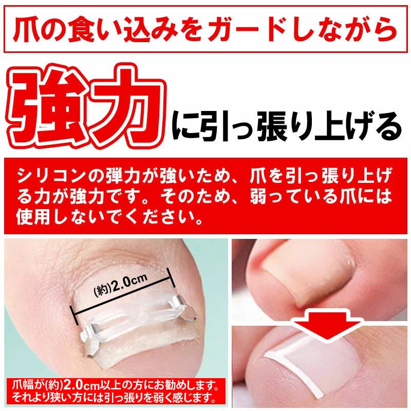 まきづめ 巻き爪 ケア ネイルケア ガード 巻き爪ブロック 巻き爪