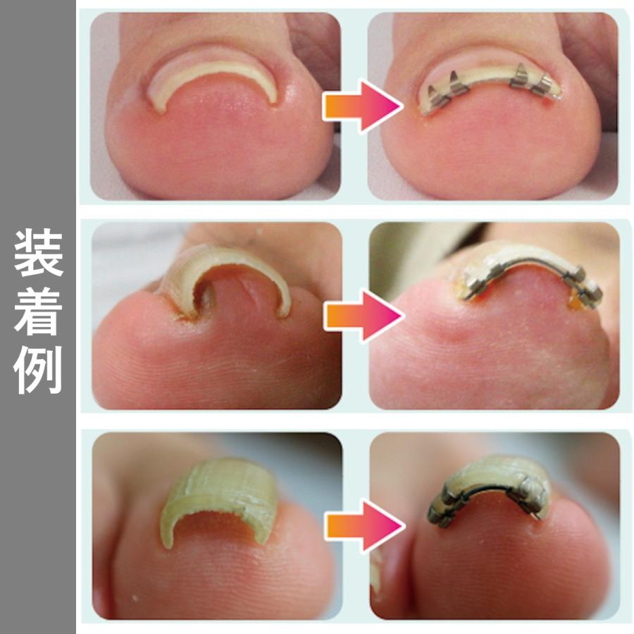 巻き爪 陥入爪 治療 まきづめ矯正 自分で治す まき爪 痛い 治し方｜bengara-ya｜11