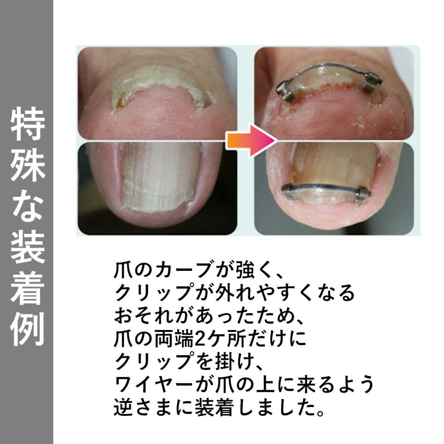 巻き爪 陥入爪 治療 まきづめ矯正 自分で治す まき爪 痛い 治し方｜bengara-ya｜18