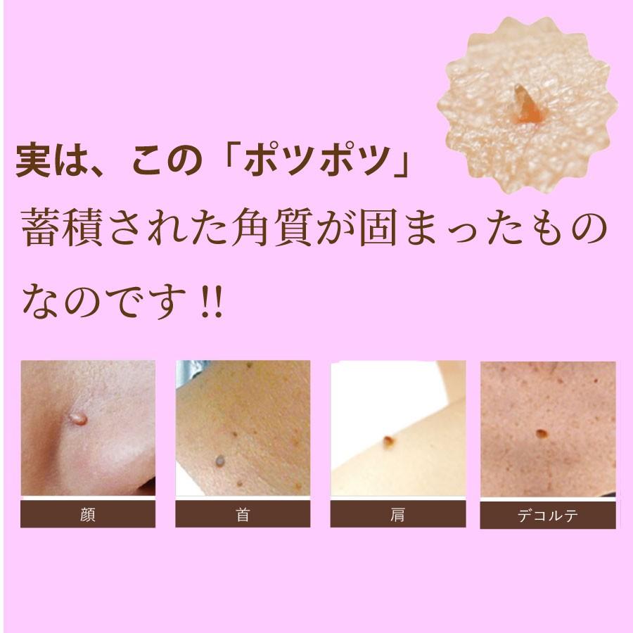 首 の イボ 自分 で 取る