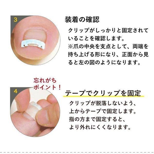 当日出荷 特典ニチバンテープ付 ドクター・ショール 巻き爪用クリップ 巻き爪矯正 S/M/Lサイズ :mys23-6149-select:Shop de Clinic - 通販 - Yahoo!ショッピング 当日出荷 特典ニチバンテープ付 ドクター・ショール 巻き爪用クリップ 巻き爪矯正 S/M/Lサイズ :mys23-6149-select:Shop de Clinic - 通販 - Yahoo!ショッピング