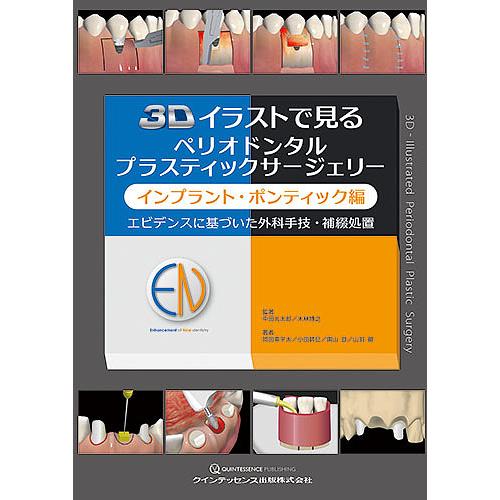 3Dイラストで見る ペリオドンタル プラスティックサージェリー 3Dイラストで見るペリオドンタルプラスティックサージェリー