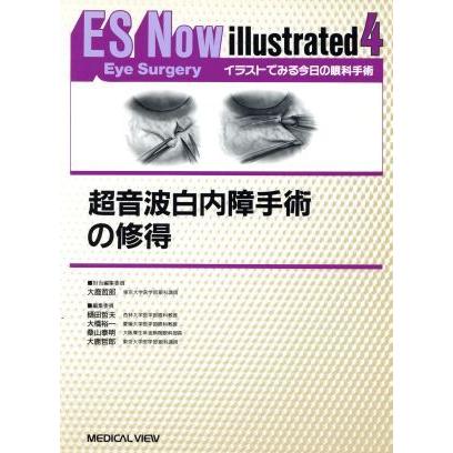 超音波白内障手術の修得 ｅｓ ｎｏｗ ｉｌｌｕｓｔｒａｔｅｄ イラストでみる今日の眼科手術４ 大鹿哲郎 編者 ブックオフ ヤフーショッピング店 通販 Yahoo ショッピング