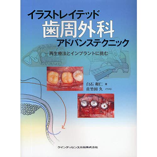 イラストレイテッド歯周外科アドバンステクニック : 再生療法とインプラントに挑む イラストレイテッド歯周外科アドバンステクニック 再生療法と