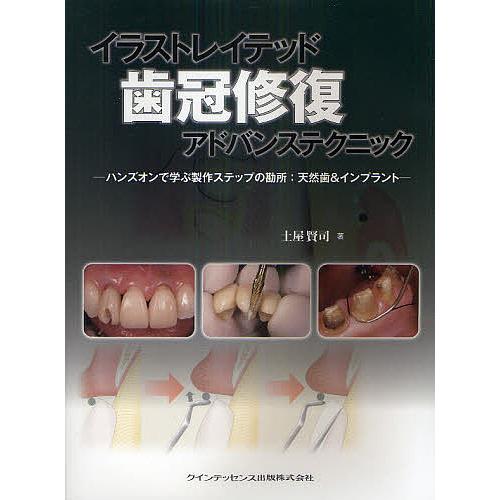 日曜はクーポン有 イラストレイテッド歯冠修復アドバンステクニック ハンズオンで学ぶ製作ステップの勘所 天然歯 インプラント 土屋賢司 Bookfan Paypayモール店 通販 Paypayモール