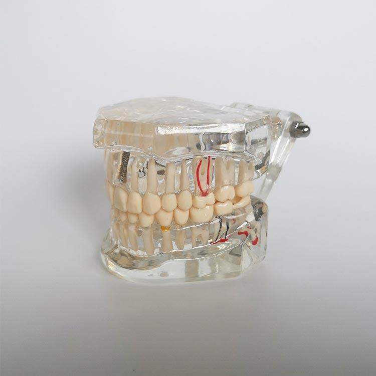 歯模型 透明 歯の模型 歯 模型 差し歯 歯医者 人体解剖モデル 歯 模型 歯 モデル 開閉式 歯科 口腔内模型 クリニック 人体模型 歯根 研究 説｜bridgebridgee｜02