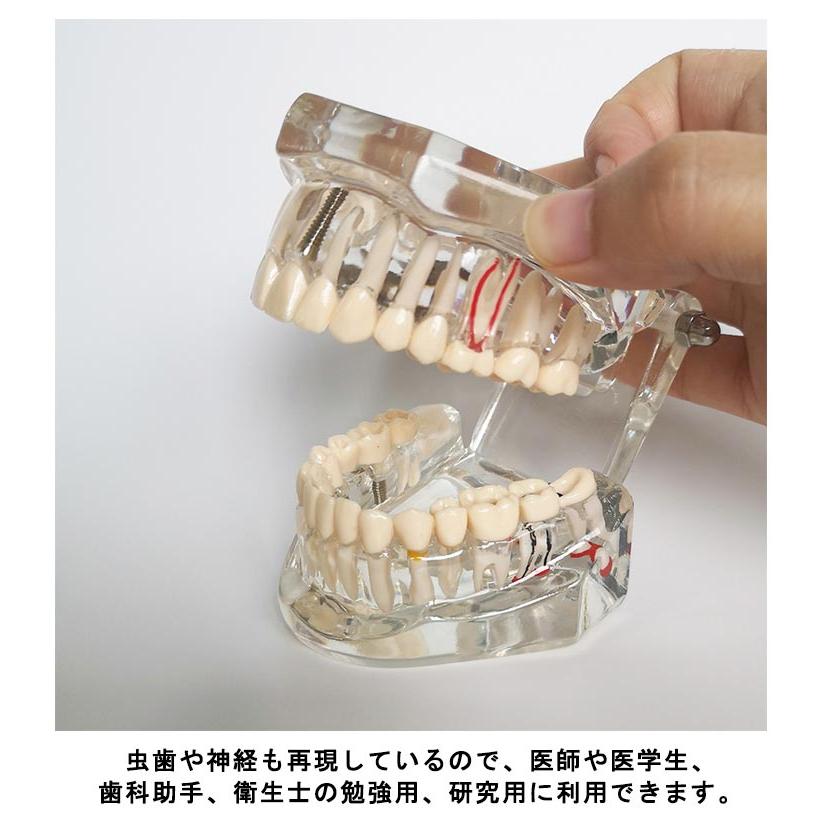 歯模型 透明 歯の模型 歯 模型 差し歯 歯医者 人体解剖モデル モデル