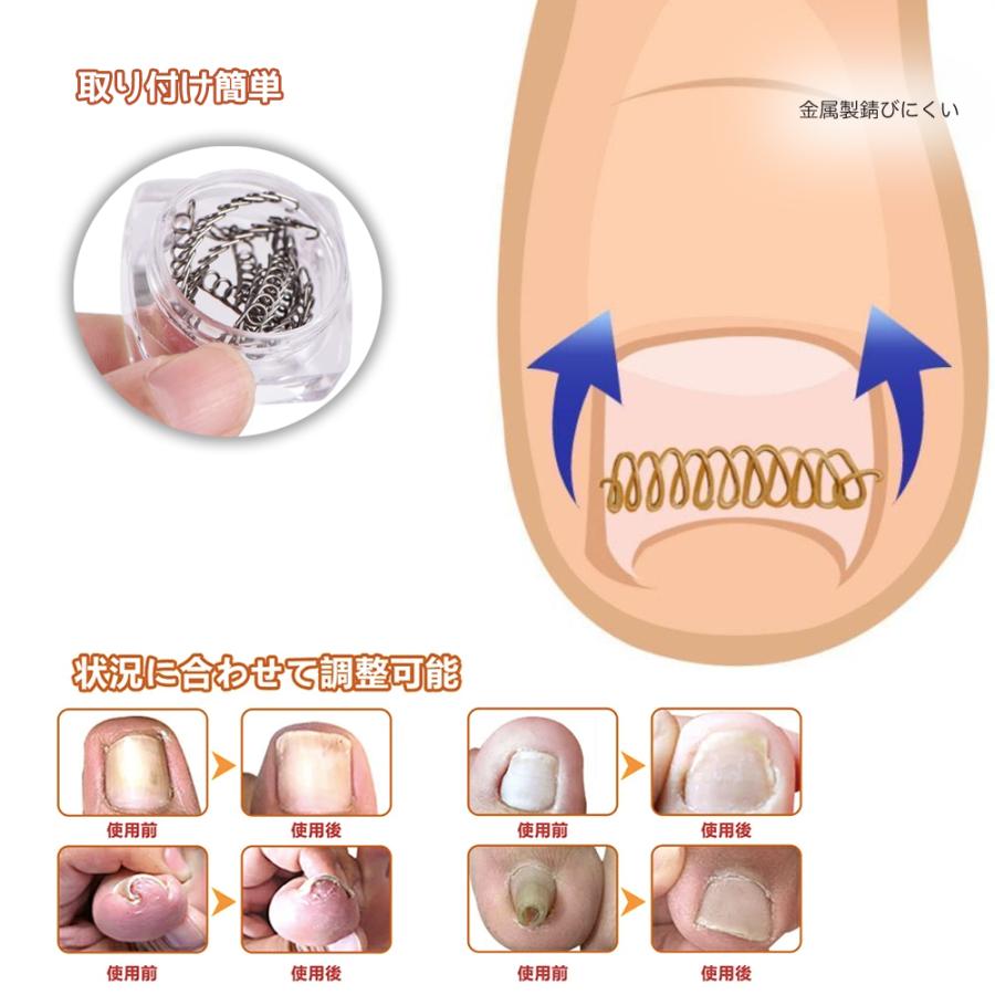 巻き爪 矯正 巻き爪チェーン ワイヤー 自宅で治す 矯正器具｜civil-life｜03