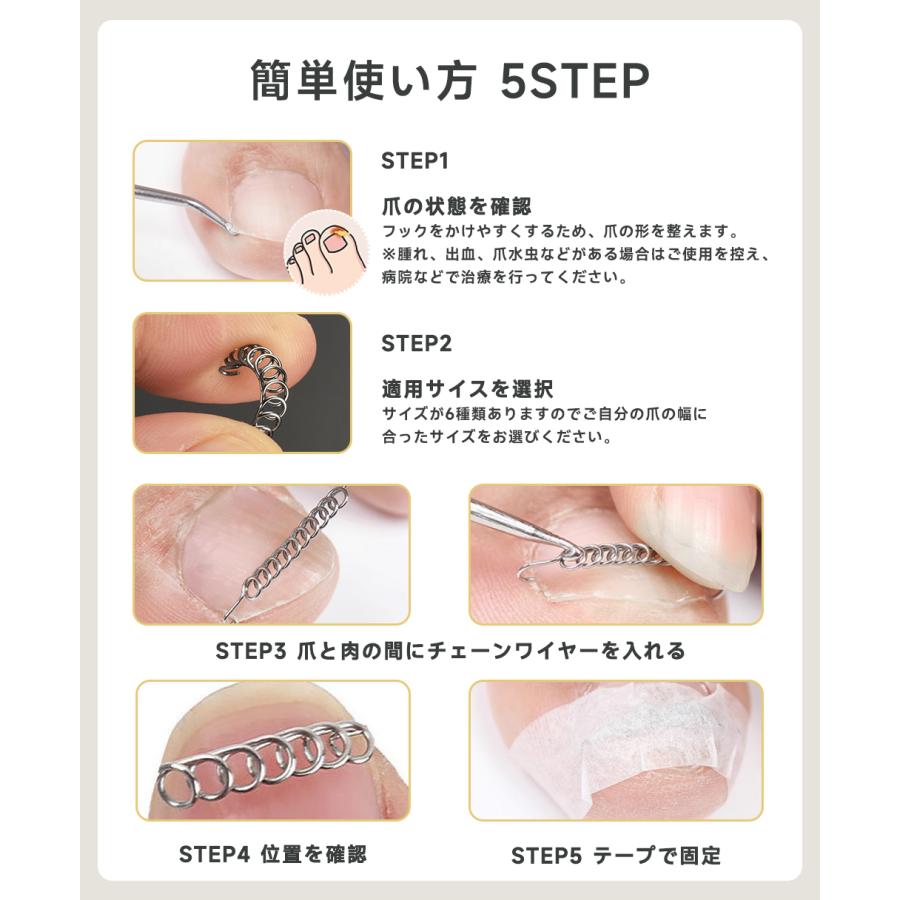 巻き爪 矯正 巻き爪チェーン ワイヤー 自宅で治す 矯正器具 巻き爪 矯正 巻き爪チェーン ワイヤー 自宅で治す 矯正器具