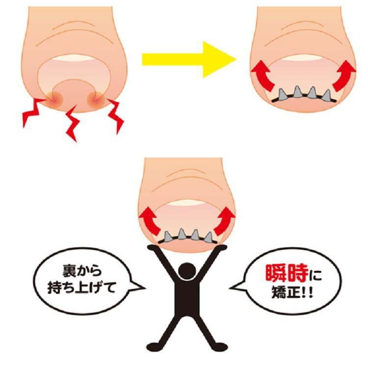 リニューアル まきづめリフト まき爪 補正 ワイヤー 1個入り 巻き爪 巻