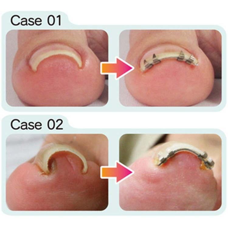 リニューアル まきづめリフト まき爪 補正 ワイヤー 1個入り 巻き爪 巻