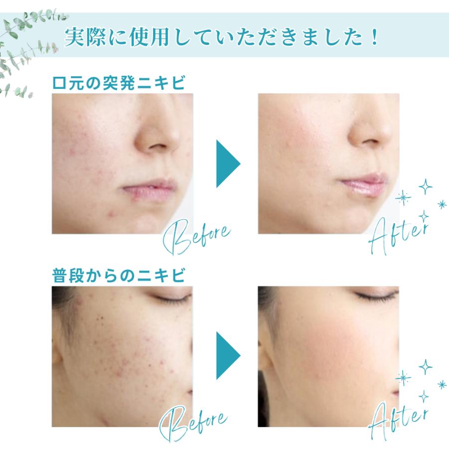 ACNES LABO（アクネスラボ） BBクリーム ニキビケア ファンデーション 