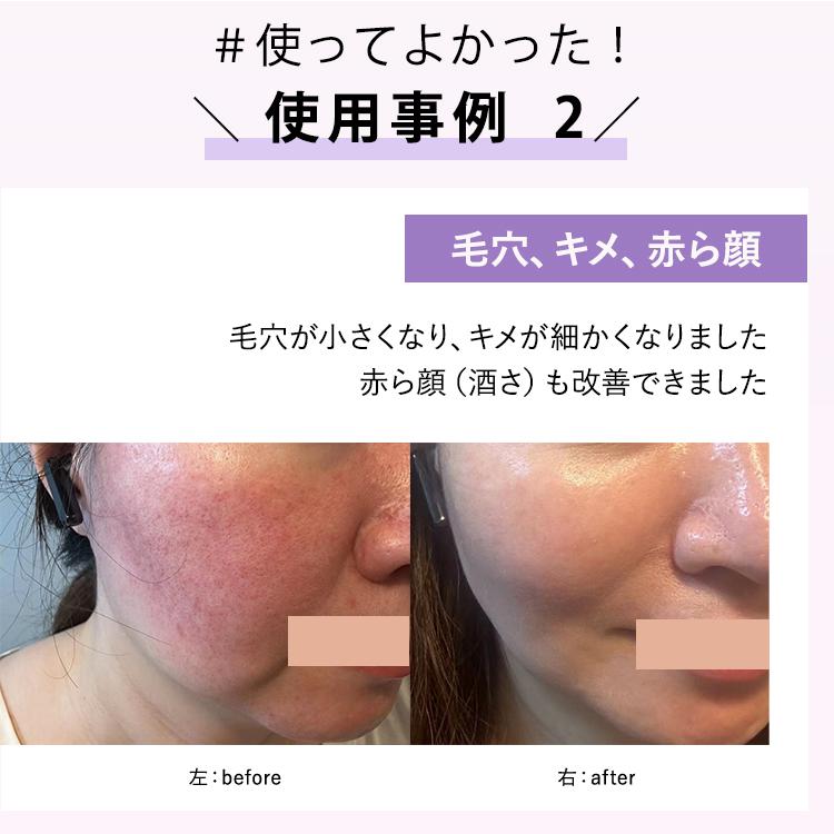 公式！ポイント10倍】DENSHINDO プラズマ エアシャワー 美顔器