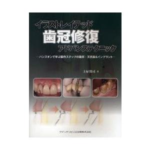 イラストレイテッド歯冠修復アドバンステクニック ハンズオンで