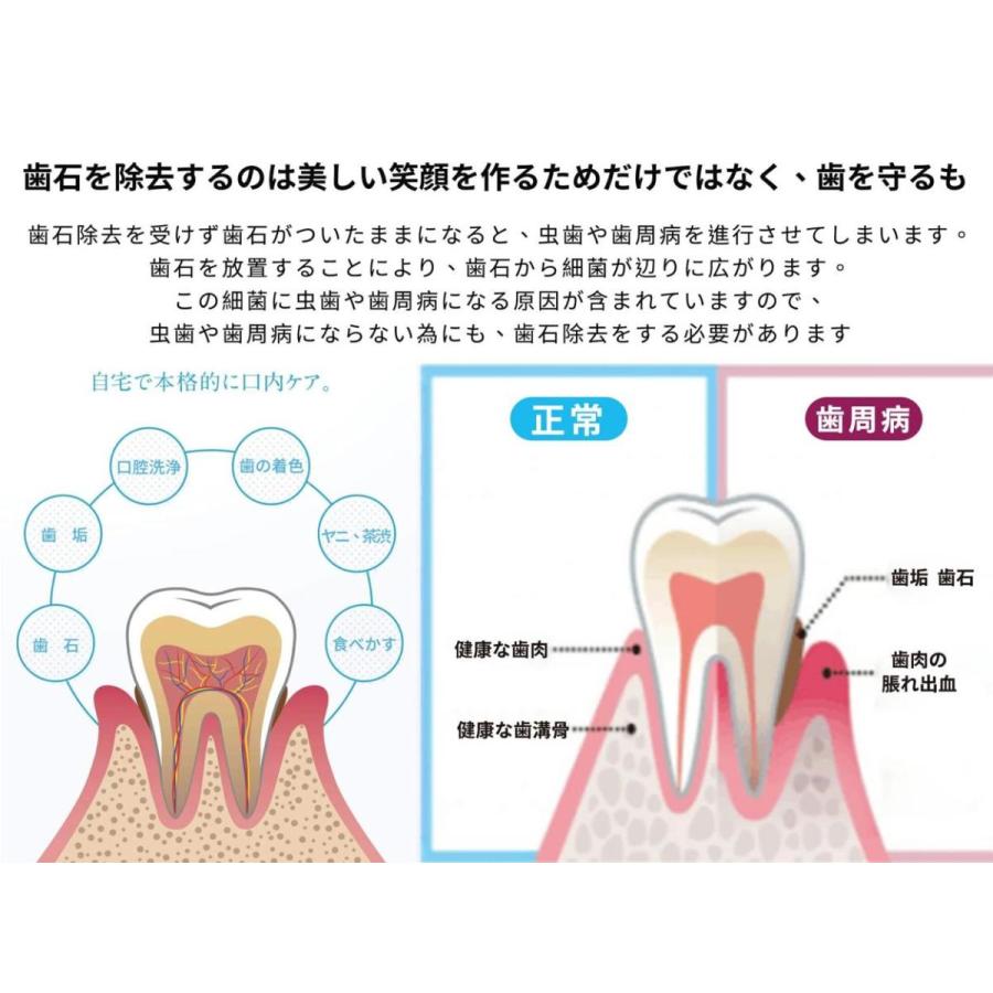 即日発送 歯石取り 超音波 スケーラー 歯用ツール 電動 歯クリーナー 歯石 口臭 口腔洗浄器 除去 歯垢とり器具 電動歯ブラシ 自分で取る 安値 充電式 Ipx6防水