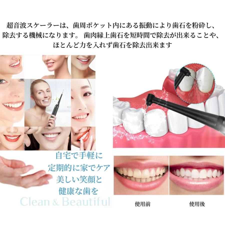 即日発送 歯石取り 超音波 スケーラー 歯用ツール 電動 歯クリーナー 歯石 口臭 口腔洗浄器 除去 歯垢とり器具 電動歯ブラシ 自分で取る 安値 充電式 Ipx6防水