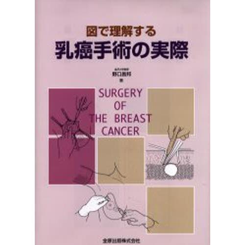 図で理解する乳癌手術の実際