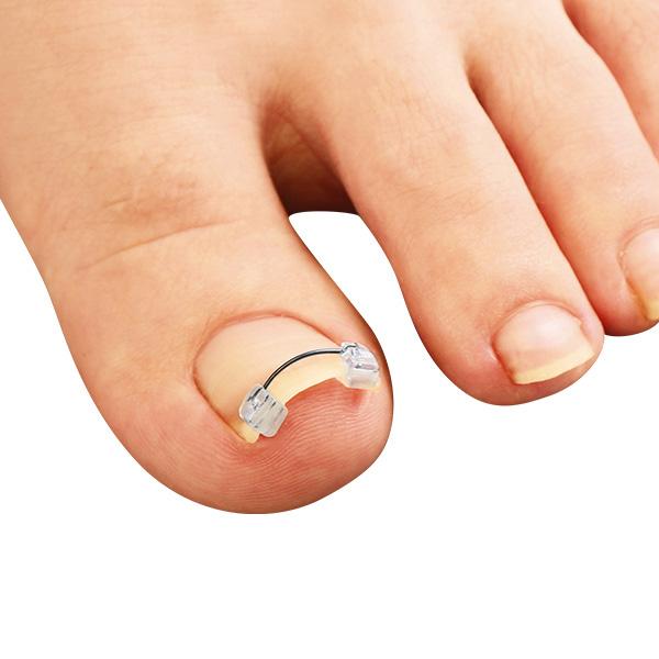 一般医療機器巻き爪ワイヤーガード | 