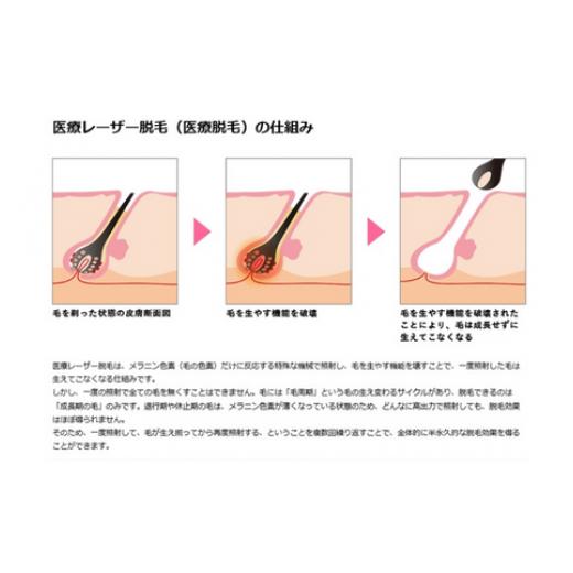 【超美品】 ふるさと納税 神奈川県 藤沢市 男性脱毛 ハイジニーナ VIO 1回 藤沢院／SBC 湘南 美容 クリニック ふるさと納税 脱毛 医療 レーザー 利用券 チケット 神奈川県… 【TMF9140701822】(32200円)