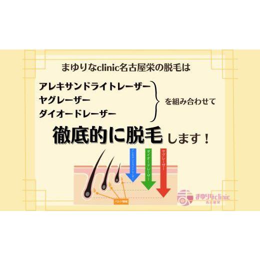 ふるさと納税 愛知県 名古屋市 【男性医療脱毛】VIO　5回コース｜furusatochoice｜05