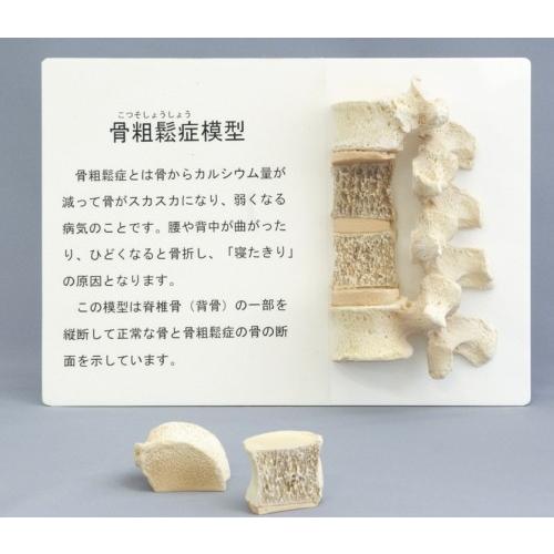 骨粗鬆症比較模型 : 学林舎 - 通販 - Yahoo!ショッピング