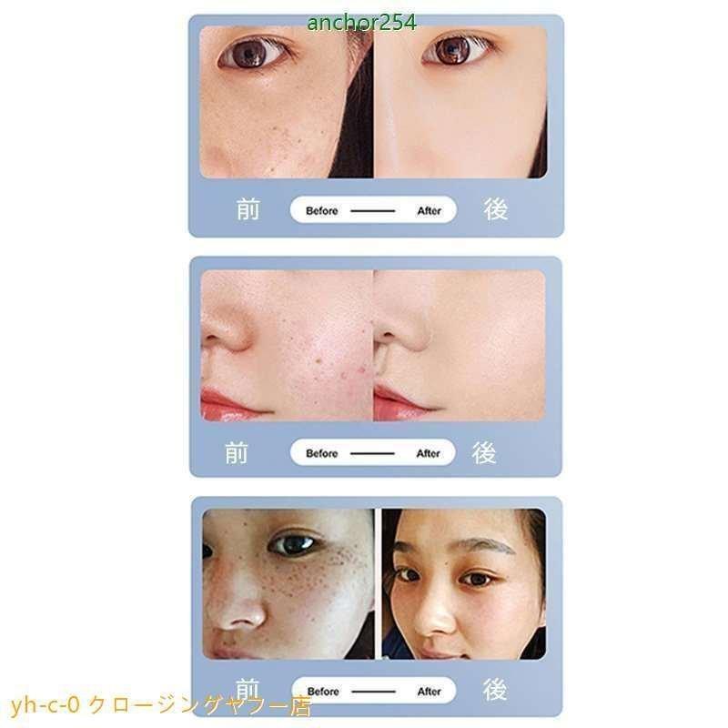 美顔器 ピコレーザー 美顔器 ほくろそばかす除去 シミ 斑 青色レーザー 赤色レーザー 美容機器 レーザー そばかす 毛穴 シワ 傷跡 ピコ秒レーザー 美顔器 そばかす 毛穴 シワ