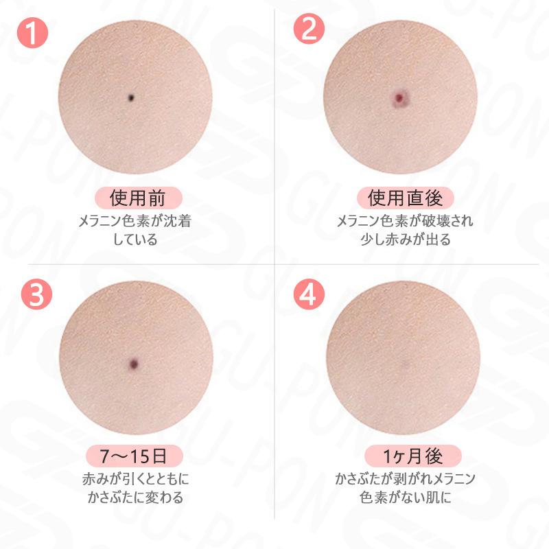 レーザーペン シミ取り 11 Offクーポン 週末限定 ほくろ イボ 口コミ 効果 2021 そばかす 消す方法 除去 自分で 自宅 男性 指 顔 家庭用 美顔器 日本語取説 即納 Ldzb000gz210720 グーポンショップ 通販 Yahoo ショッピング