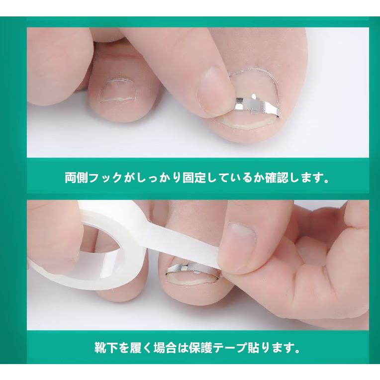 巻き爪ケアクリップ ワイヤー ガード 爪ブロック テープ 巻きづめ 治し方 矯正 テープ 巻きづめ 靴 巻爪 対策 足の巻き爪 防止 Tumecyousei アキ 通販 Yahoo ショッピング