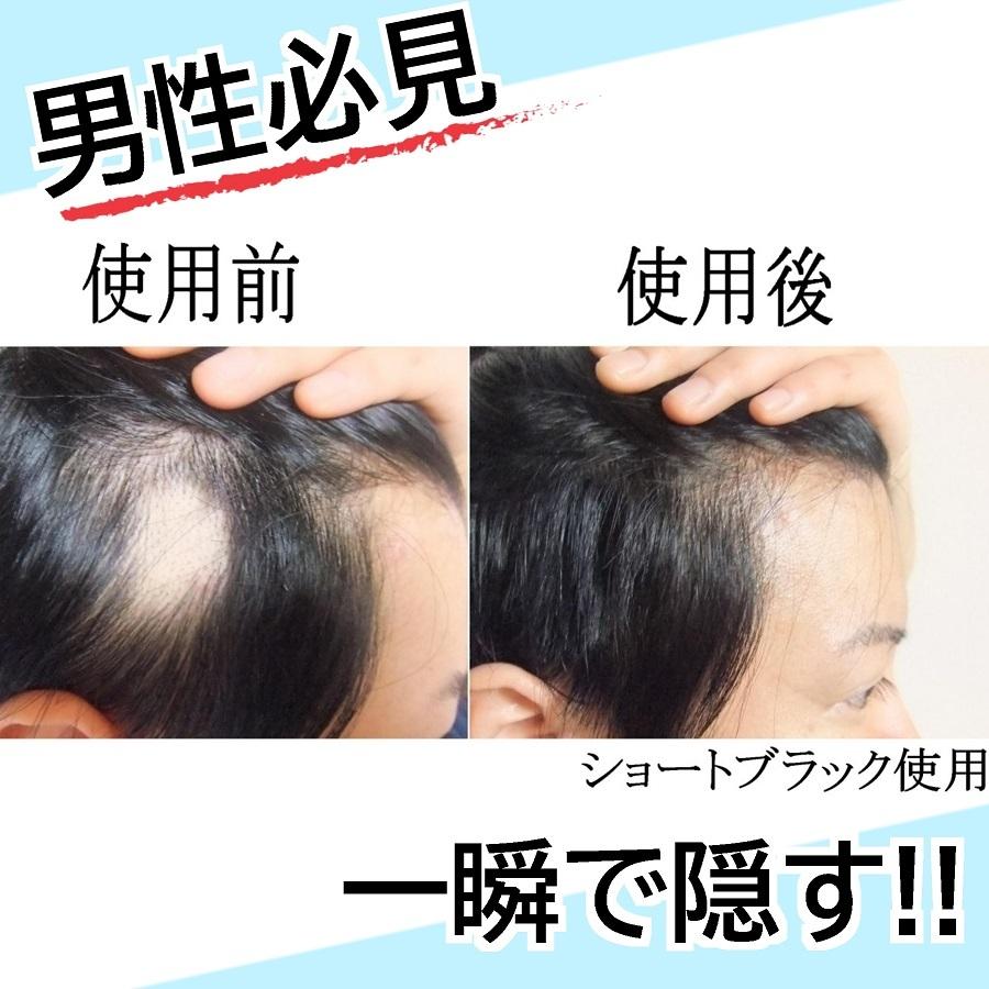 男性 円形脱毛症 隠し方 部分 ウィッグ エクステ つけ毛 Mサイズ 男性 円形脱毛症 隠し方 部分 ウィッグ エクステ つけ毛 Mサイズ